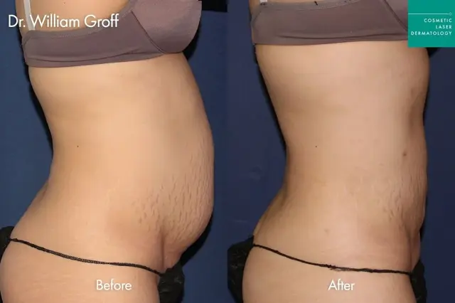 Liposuction result at Cosmetic Laser Dermatology in San Diego, CA