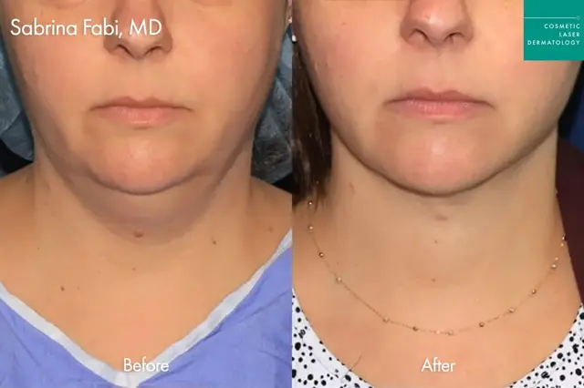 Kybella result at Cosmetic Laser Dermatology in San Diego, CA
