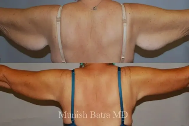 Arm Lift result at Coastal Plastic Surgeons in San Diego, CA