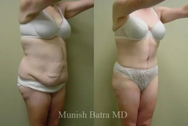 Mini Tummy Tuck result at Coastal Plastic Surgeons in San Diego, CA