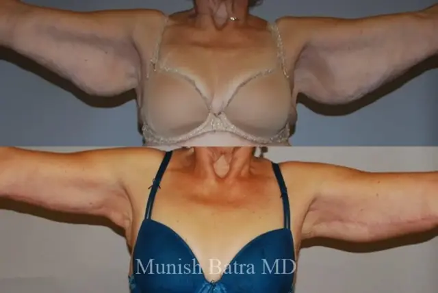 Arm Lift result at Coastal Plastic Surgeons in San Diego, CA