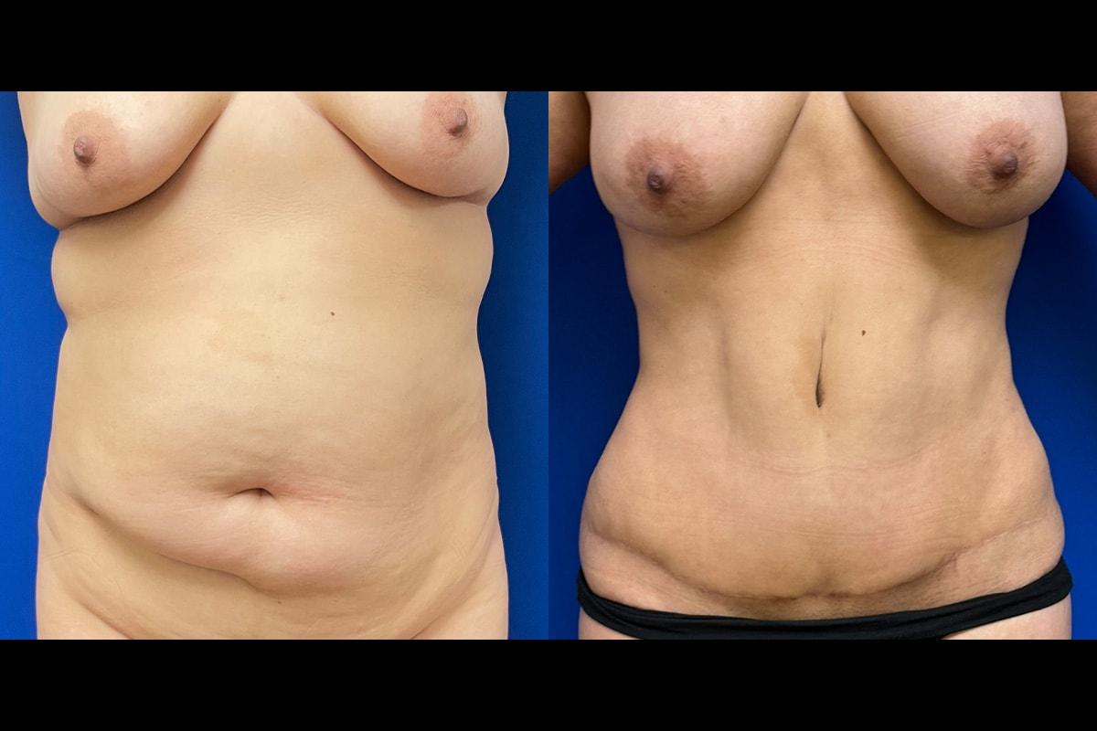 Graw Beauty (Grace Graw, MD) mommy makeover result — Palo Alto, CA