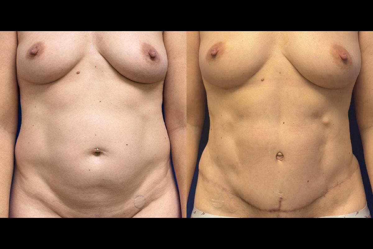 Graw Beauty (Grace Graw, MD) tummy tuck result — Palo Alto, CA