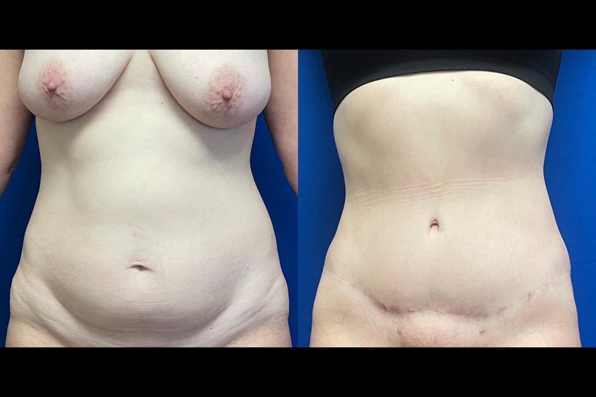 Graw Beauty (Grace Graw, MD) tummy tuck result — Palo Alto, CA