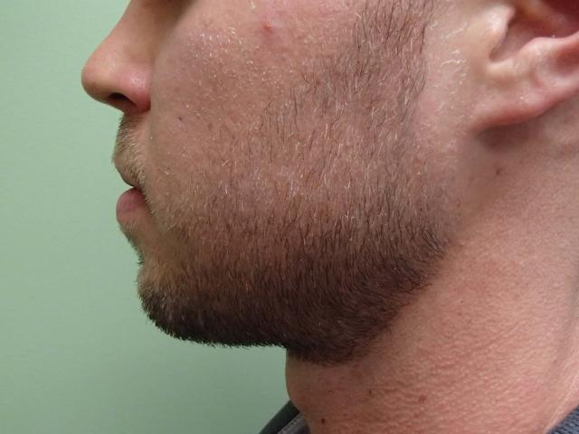 Neck Liposuction before at Timeless Plastic Surgery in Sugar Land, TX