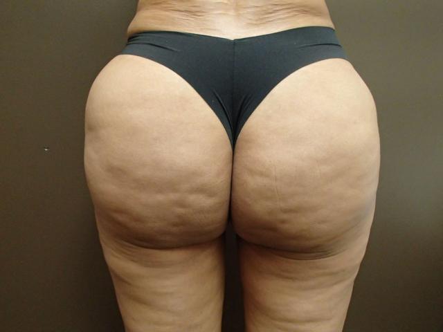 Brazilian Butt Lift after at Timeless Plastic Surgery in Sugar Land, TX
