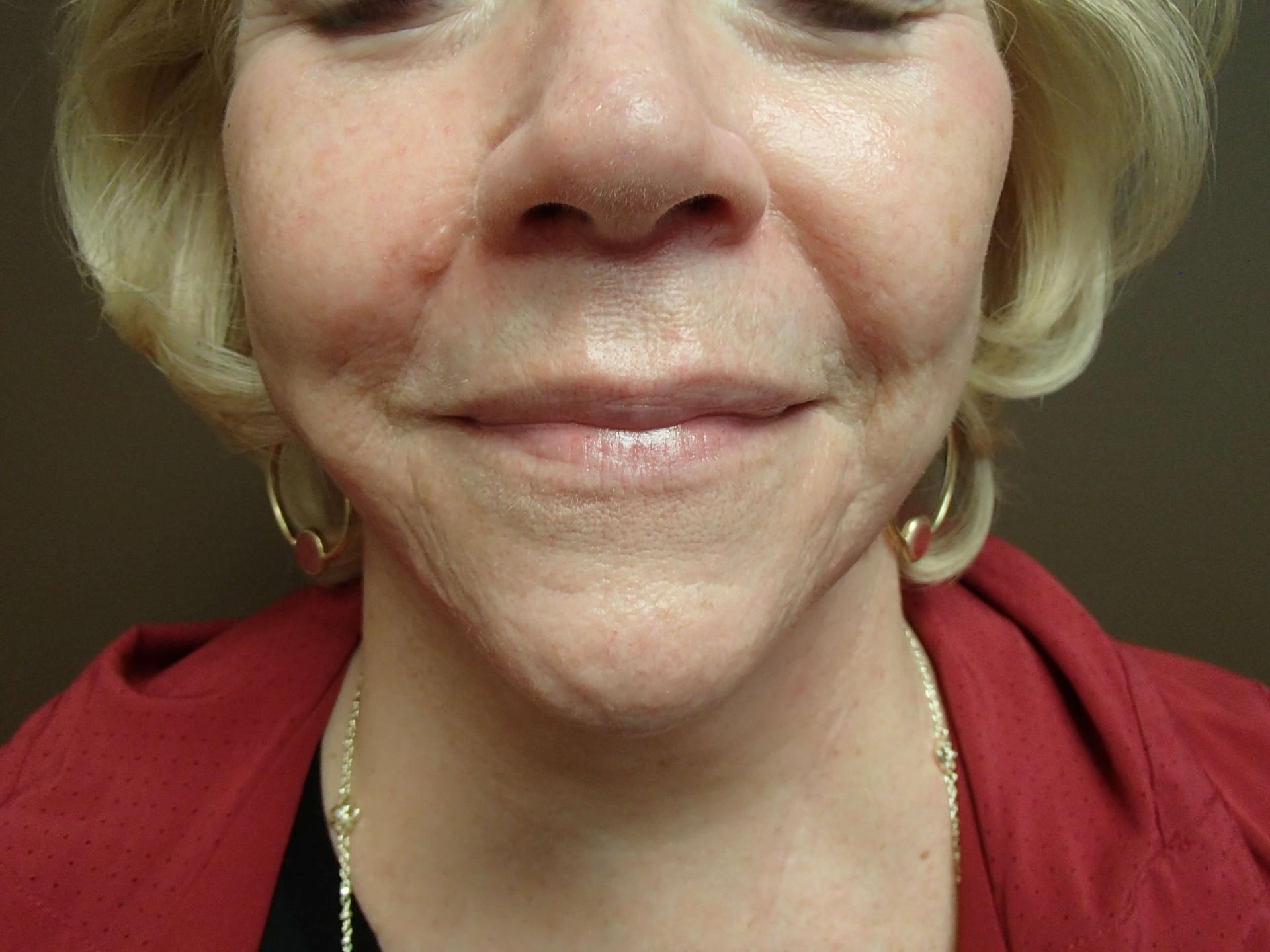 Timeless Plastic Surgery facelift after — Sugar Land, TX