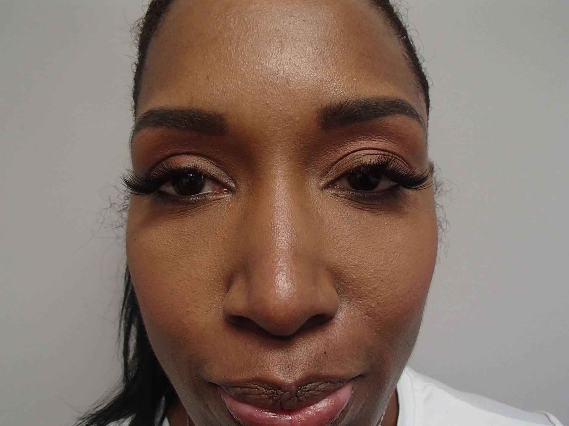 Timeless Plastic Surgery rhinoplasty after — Sugar Land, TX
