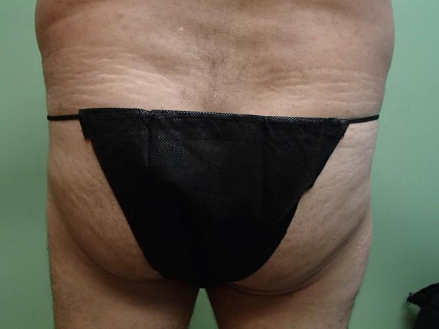 Brazilian Butt Lift before at Timeless Plastic Surgery in Sugar Land, TX