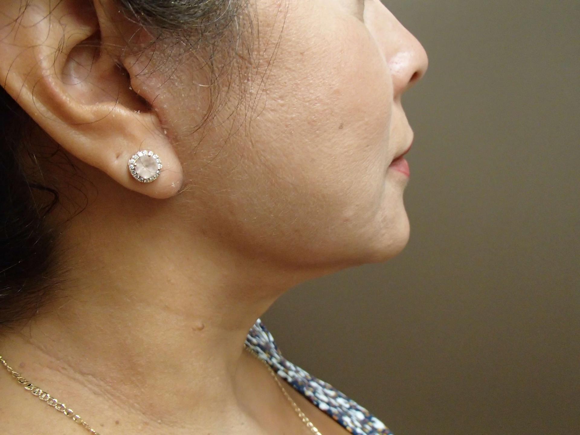 Timeless Plastic Surgery facelift after — Sugar Land, TX