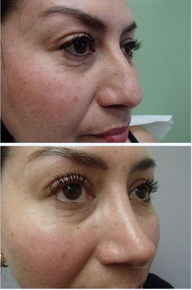 Timeless Plastic Surgery rhinoplasty after — Sugar Land, TX