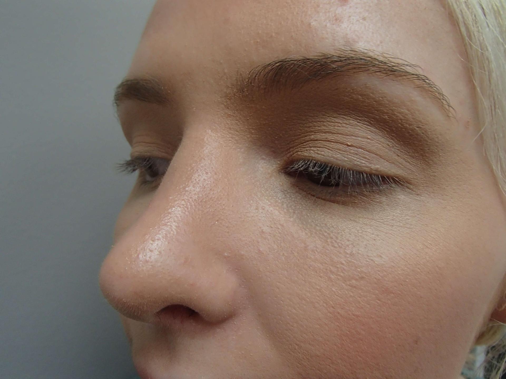 Timeless Plastic Surgery rhinoplasty after — Sugar Land, TX