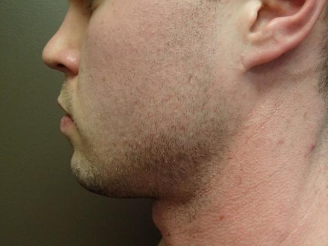Neck Liposuction after at Timeless Plastic Surgery in Sugar Land, TX