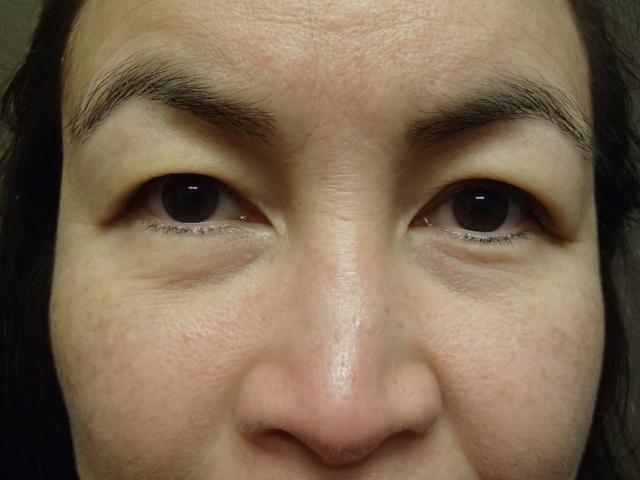 Blepharoplasty before at Timeless Plastic Surgery in Sugar Land, TX