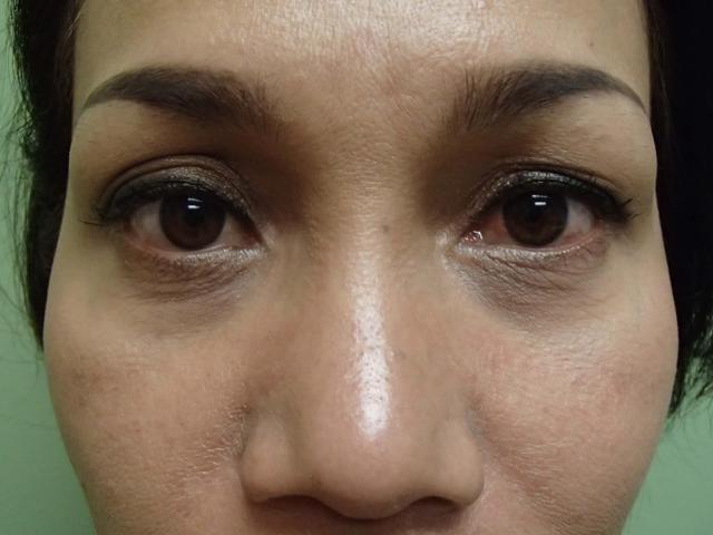 Blepharoplasty before at Timeless Plastic Surgery in Sugar Land, TX