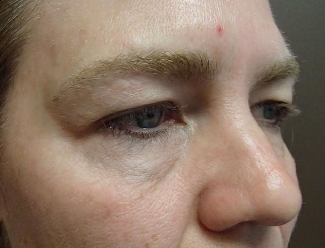 Blepharoplasty before at Timeless Plastic Surgery in Sugar Land, TX