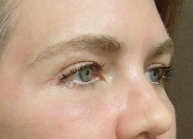 Blepharoplasty after at Timeless Plastic Surgery in Sugar Land, TX