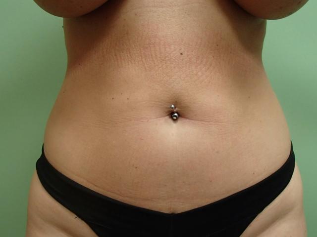 Liposuction before at Timeless Plastic Surgery in Sugar Land, TX