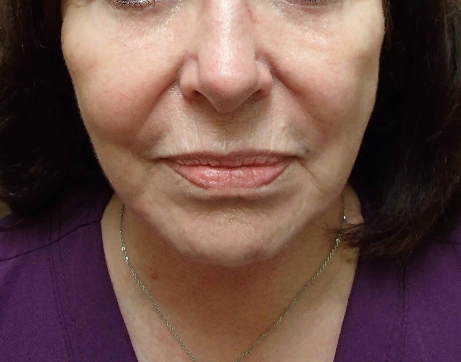 Timeless Plastic Surgery facelift after — Sugar Land, TX