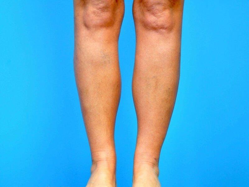 Plastic Surgery Group of Atlanta liposuction after — Alpharetta, GA