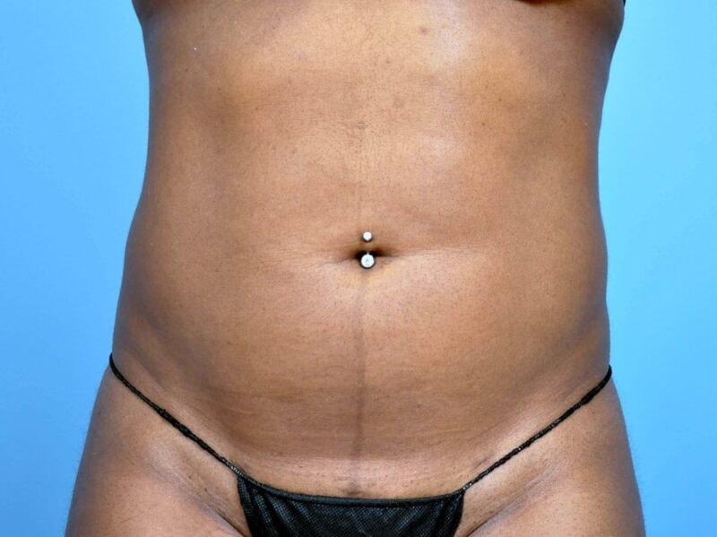 Plastic Surgery Group of Atlanta liposuction after — Alpharetta, GA