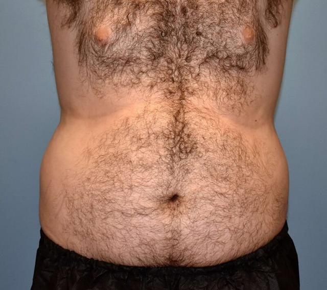 Liposuction before at Plastic Surgery Group of Atlanta in Alpharetta, GA
