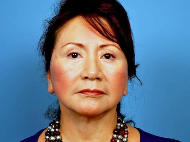 Neck Lift after at Plastic Surgery Group of Atlanta in Alpharetta, GA
