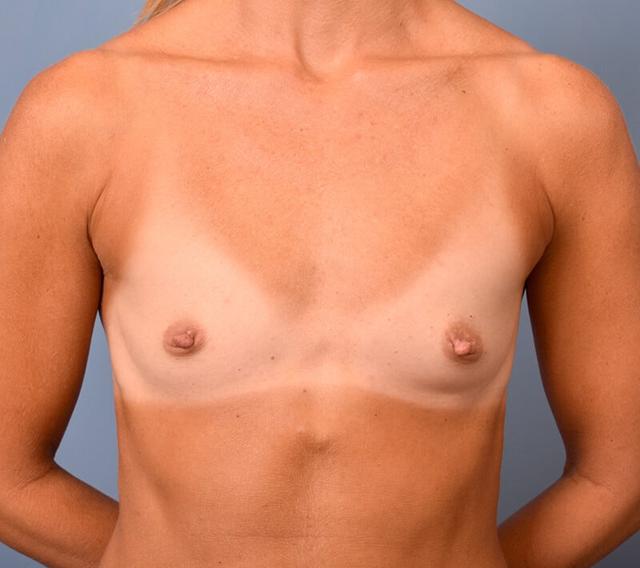 Fat Transfer Breast Augmentation before at Plastic Surgery Group of Atlanta in Alpharetta, GA