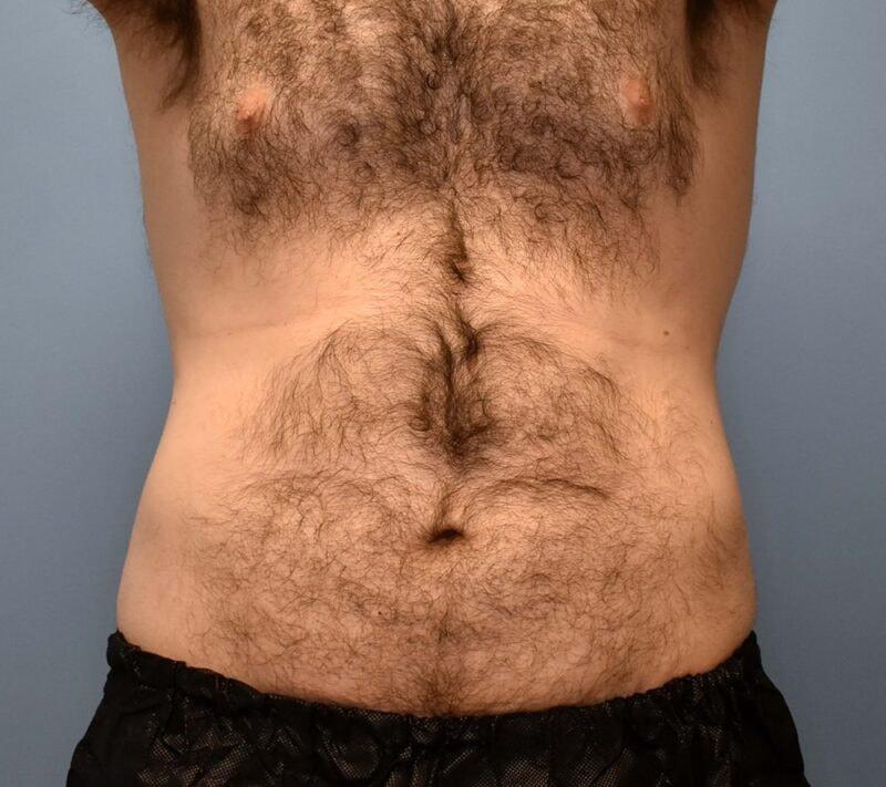 Plastic Surgery Group of Atlanta liposuction after — Alpharetta, GA