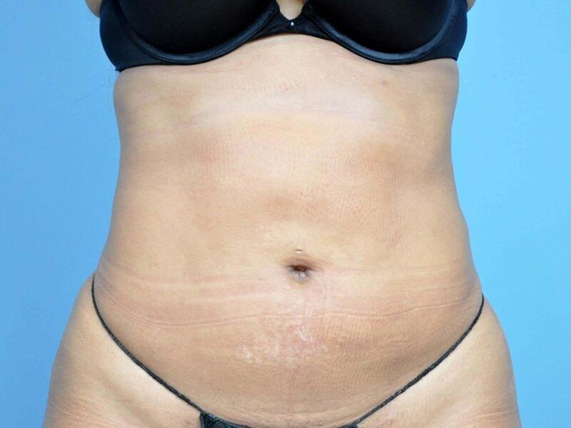 Plastic Surgery Group of Atlanta liposuction after — Alpharetta, GA