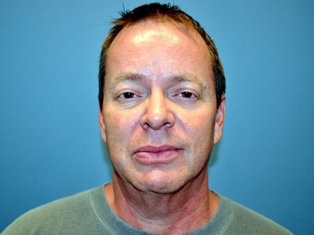 Deep Plane Facelift before at Plastic Surgery Group of Atlanta in Alpharetta, GA