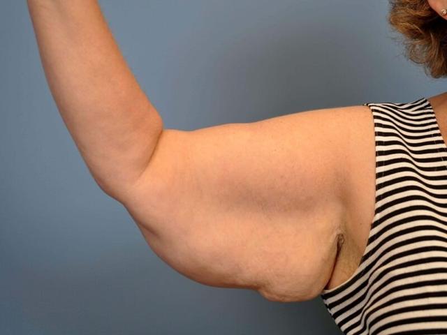 Arm Lift before at Plastic Surgery Group of Atlanta in Alpharetta, GA
