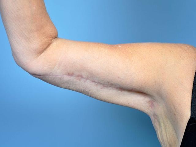 Arm Lift after at Plastic Surgery Group of Atlanta in Alpharetta, GA