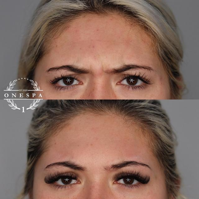 Botox result at The One Spa Chicago in Chicago, IL