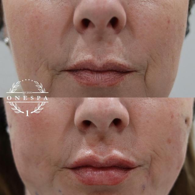 Lip Filler result at The One Spa Chicago in Chicago, IL
