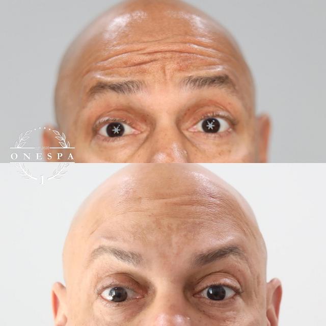 Botox result at The One Spa Chicago in Chicago, IL