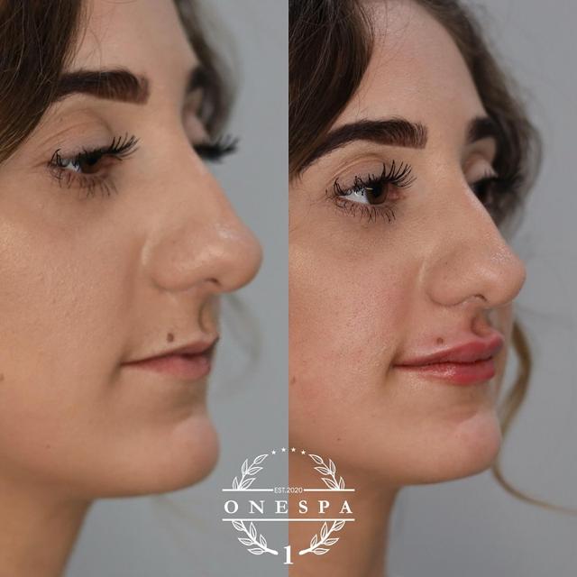Lip Filler result at The One Spa Chicago in Chicago, IL