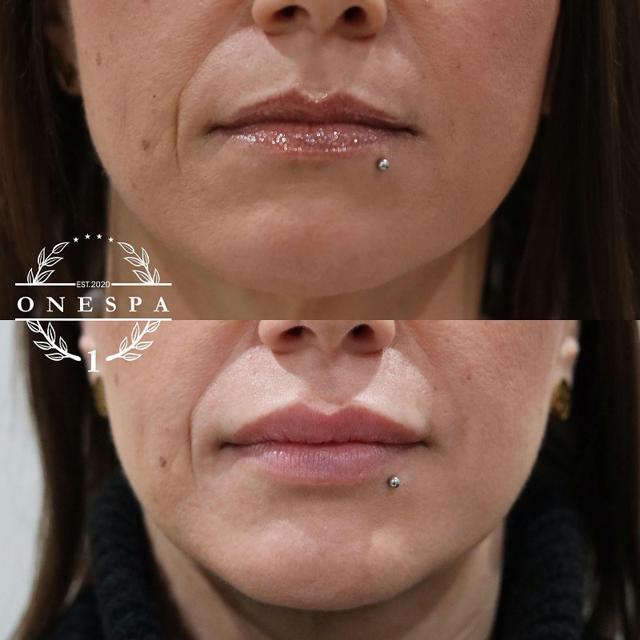 Lip Filler result at The One Spa Chicago in Chicago, IL