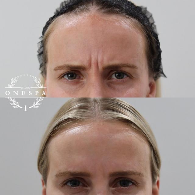 Botox result at The One Spa Chicago in Chicago, IL
