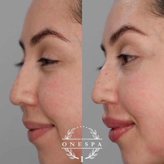 Lip Filler result at The One Spa Chicago in Chicago, IL