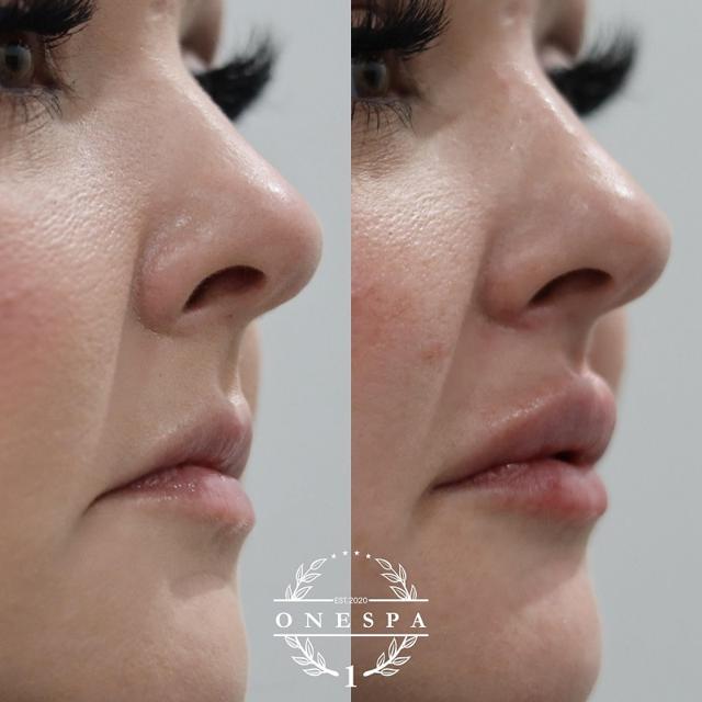 Lip Filler result at The One Spa Chicago in Chicago, IL