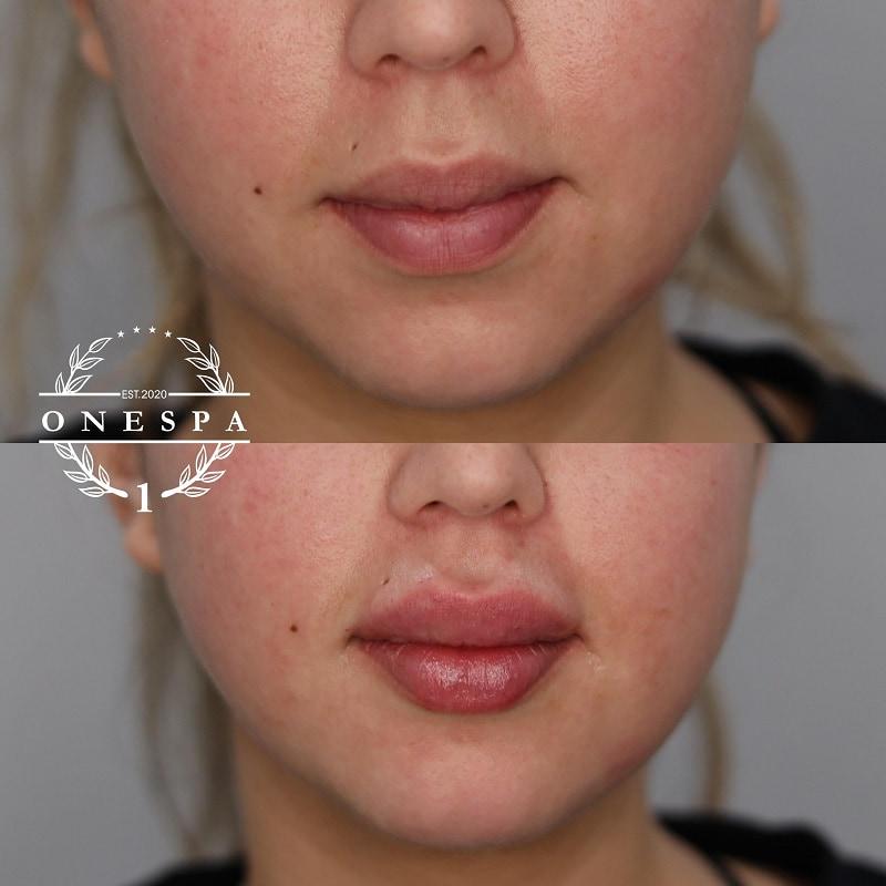 The One Spa Chicago lip filler result — Chicago, IL
