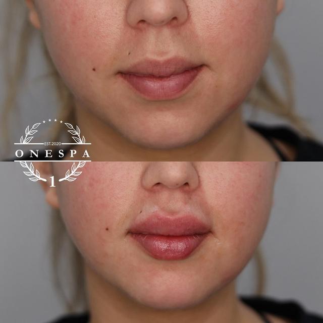 Lip Filler result at The One Spa Chicago in Chicago, IL