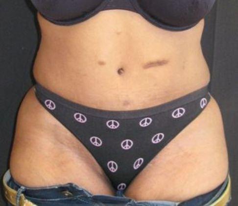 Azita Madjidi, MD tummy tuck after — Houston, TX