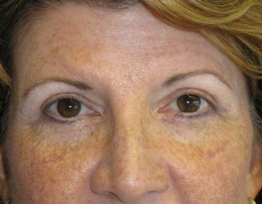 Azita Madjidi, MD eyelid lift after — Houston, TX