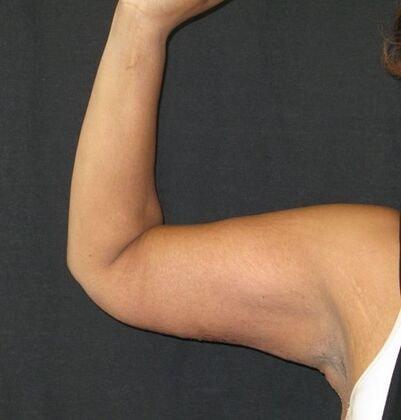 Azita Madjidi, MD arm lift after — Houston, TX
