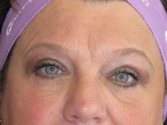 Azita Madjidi, MD eyelid lift after — Houston, TX