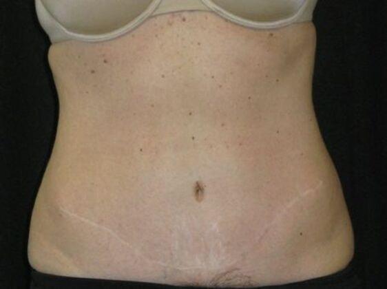 Azita Madjidi, MD tummy tuck after — Houston, TX