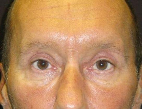 Azita Madjidi, MD eyelid lift after — Houston, TX