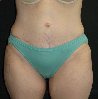 Azita Madjidi, MD tummy tuck after — Houston, TX